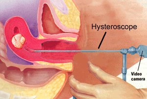 Hysteroscopic Myomectomys