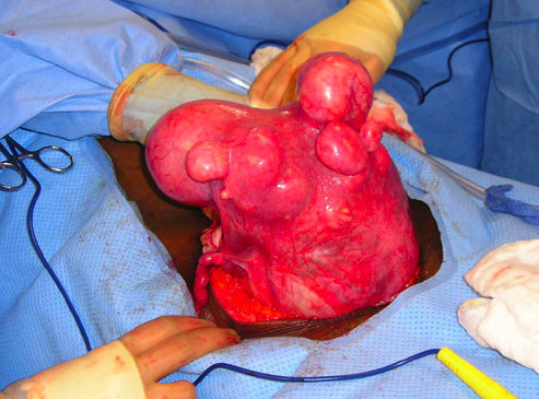 Myomectomy or Fibroid Removal