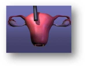 Procedure1-Uterus Mapped