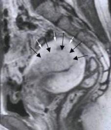 mri of adenomyosis