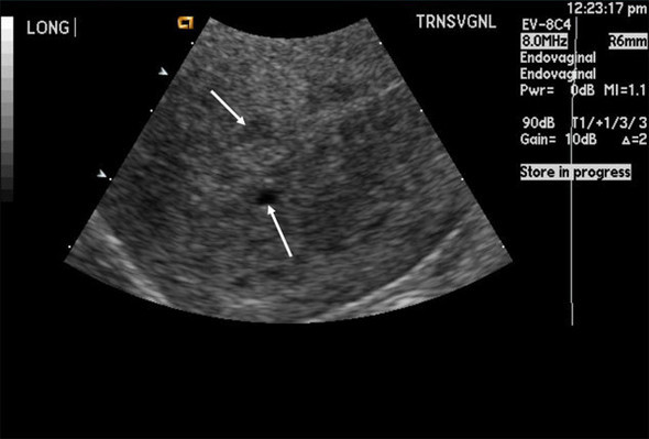 ultrasound of adenomyosis
