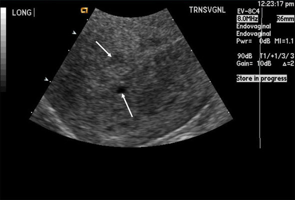 ultrasound of adenomyosis