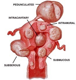 Multiple uterine fibroids