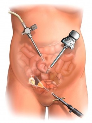 Laparoscopic hysterectomy