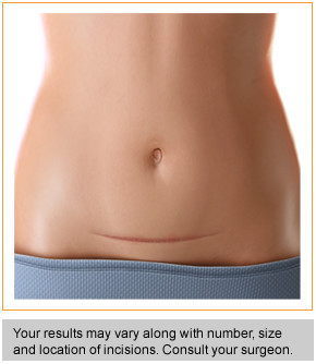 abdominal hysterectomy scar