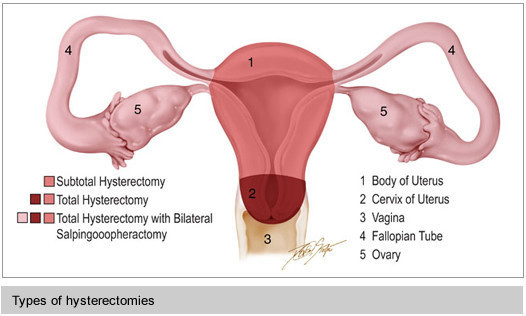 Types of Hysterectomy diagram