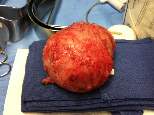 Large Fibroid