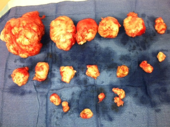 Uterine Fibroids removed