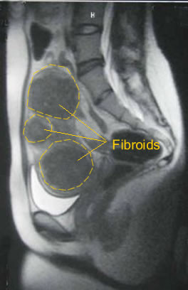 mri of fibroid