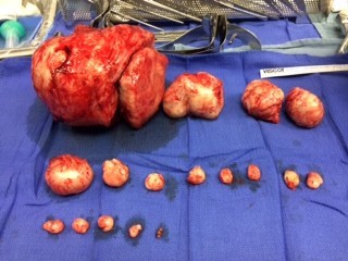 Large fibroid