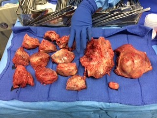 Extremely large fibroids removed through small incision