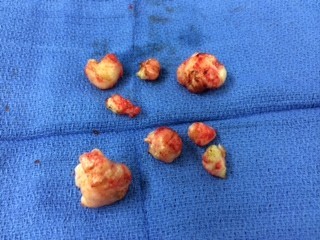 Multiple small fibroids