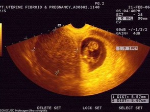 gravidez fibróide uterina