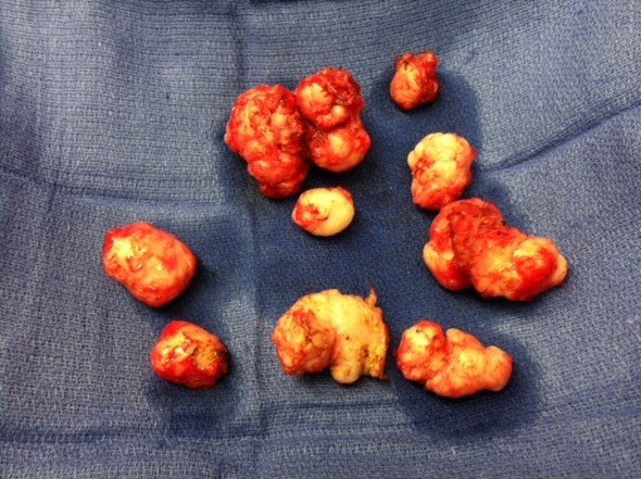 Uterine Fibroids