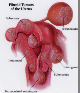 uterine fibroids