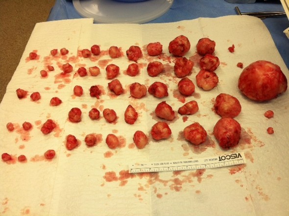 Many fibroids removed